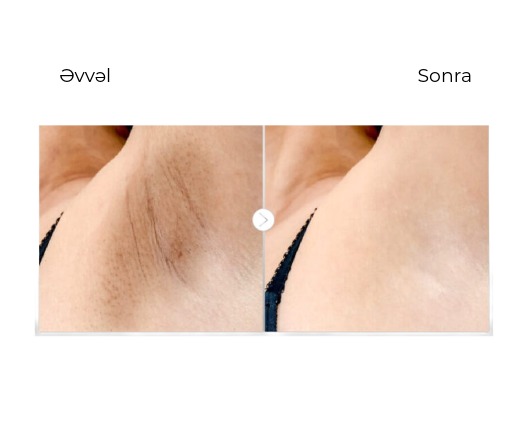 Candela Mini GentleLase